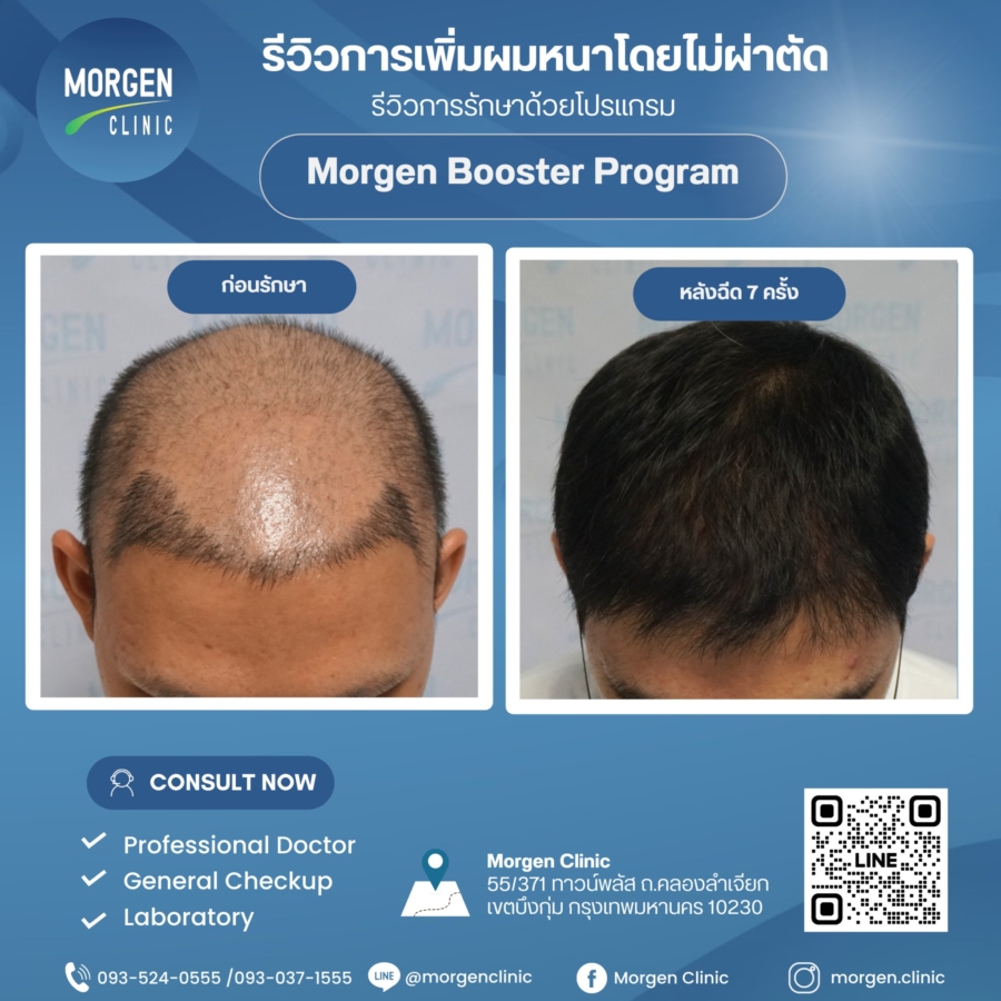 มอเก้นคลินิก ฉลองครบรอบ 5 ปี เปิดตัวโปรแกรมปลูกผมโดยไม่ต้องผ่าตัด  พร้อมมอบส่วนลดพิเศษถึง 30%